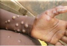 MPOX: Taita Taveta County Tightens Safety Amid Increased Surveillance As Africa Reports Cases